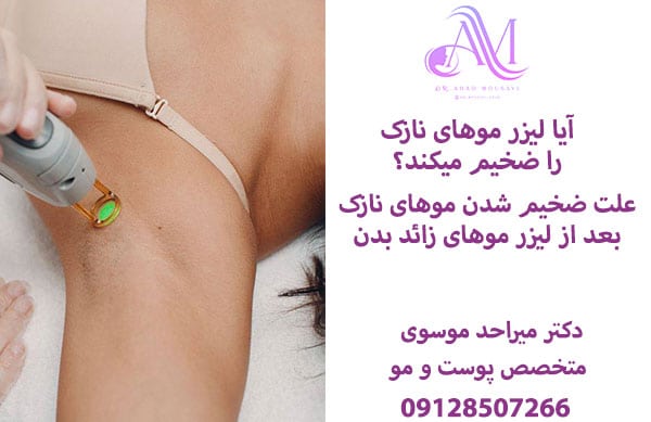 علت ضخیم شدن موهای نازک بعد از لیزر