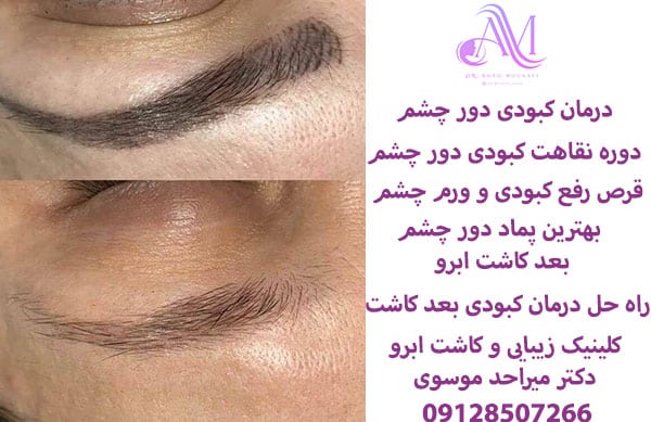 درمان کبودی دور چشم