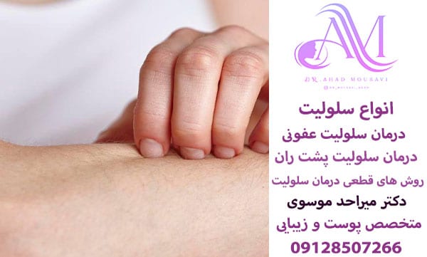 درمان سلولیت عفونی