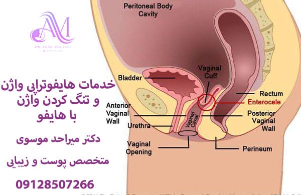 خدمات هایفوتراپی واژینال