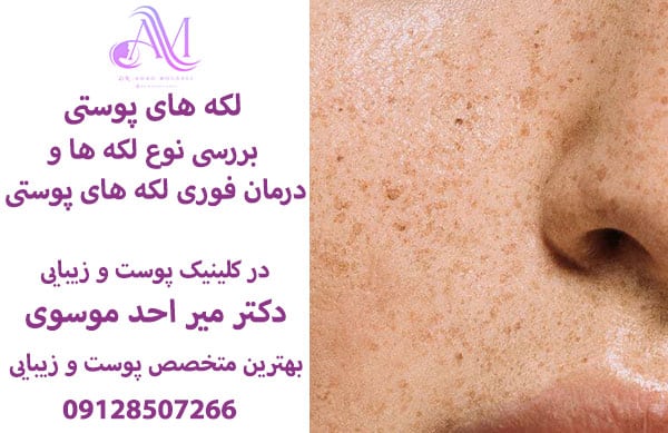 لکه های پوستی چیست