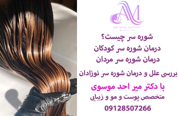 درمان شوره سر نوزادان