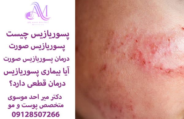 بیماری پسوریازیس چیست