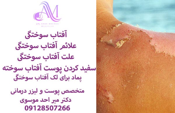 آفتاب سوختگی