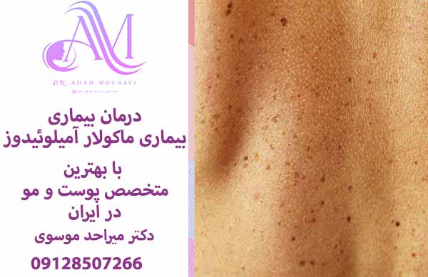 درمان بیماری ماکولار آمیلوئیدوز