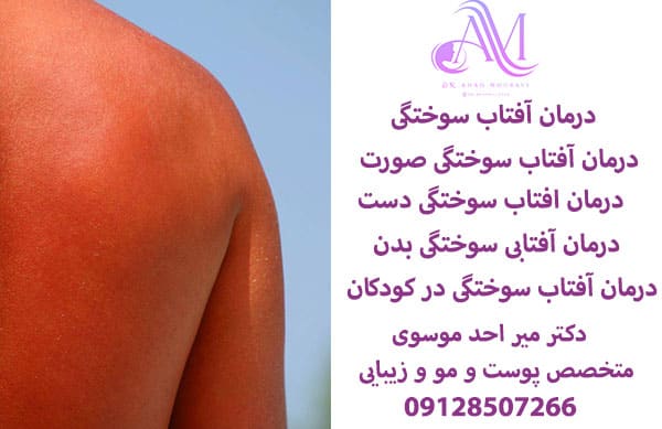 درمان آفتاب سوختگی