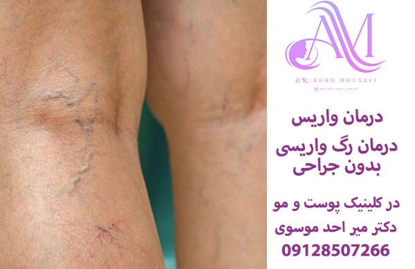 درمان واریس