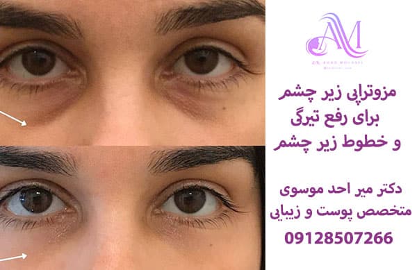 مزوتراپی زیر چشم