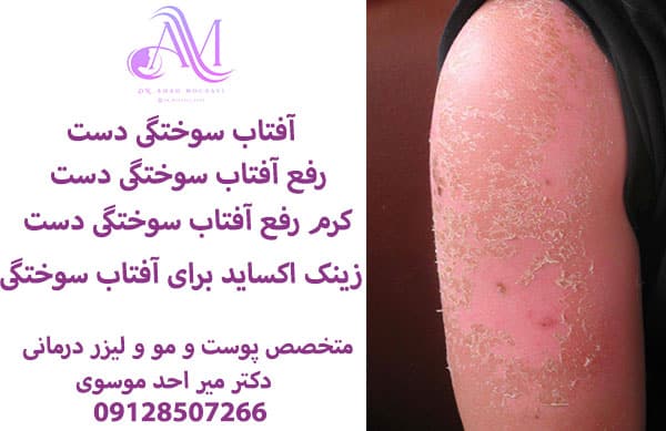 آفتاب سوختگی دست