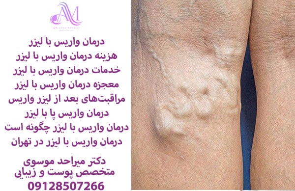درمان واریس با لیزر