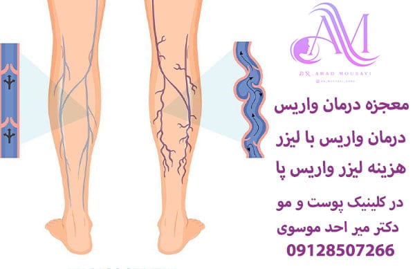 معجزه درمان واریس