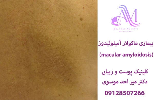 بیماری ماکولار آمیلوئیدوز