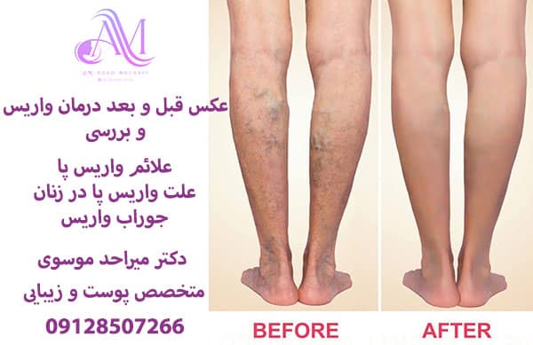 درمان واریس پا با لیزر