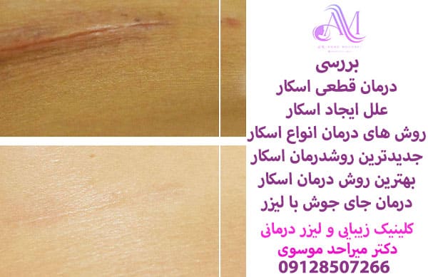 درمان قطعی اسکار