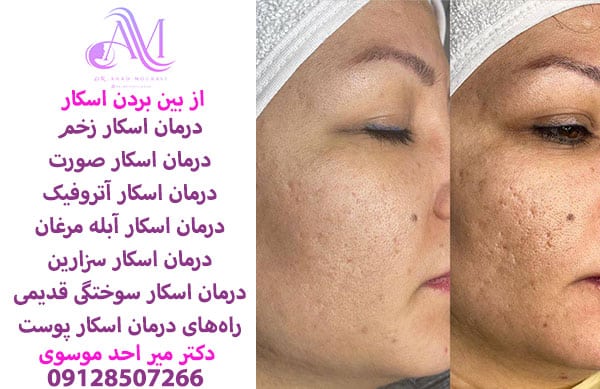 درمان اسکار زخم