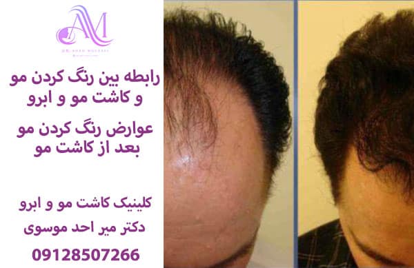 زابطه بین رنگ کردن مو و کاشت مو و ابرو