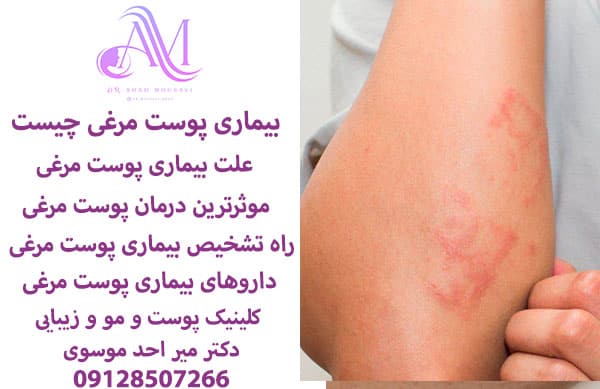 بیماری پوست مرغی چیست