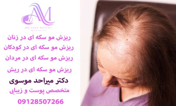 ذرمان ریزش مو سکه ای در زنان