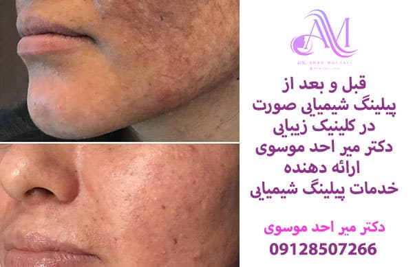 خدمات پیلینگ شیمیایی صورت