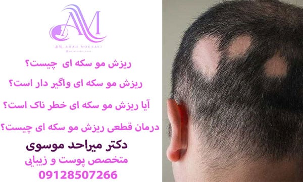 ریزش مو سکه ای