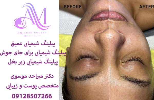 پیلینگ شیمیایی عمیق