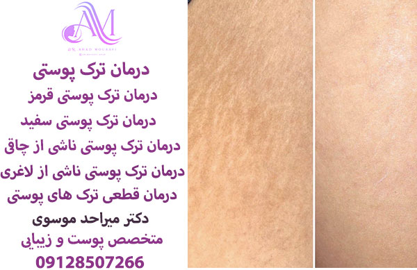 درمان ترک پوستی