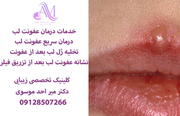 درمان سریع عفونت لب