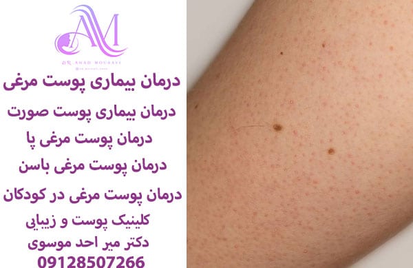 پوست مرغی یا کراتوز پیلاریس