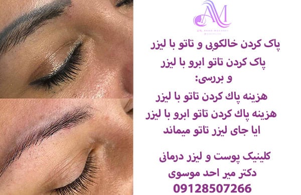 هزینه پاک کردن تاتو با لیزر