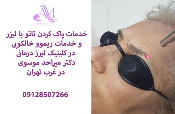 خدمات پاک کردن تاتو با لیزر