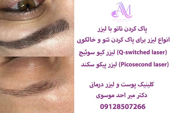 پاک کردن تاتو با لیزر