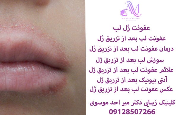 عفونت لب بعد از تزریق ژل لب