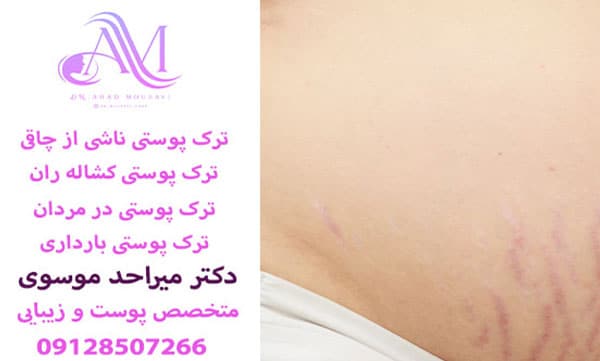 ترک پوستی بارداری