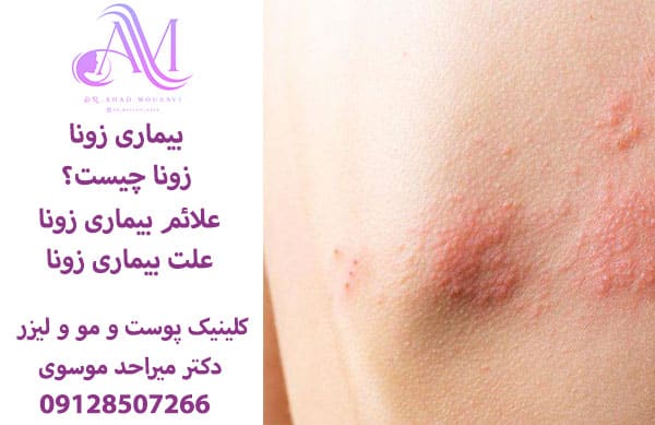 بیماری زونا