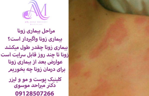 مراحل بیماری زونا