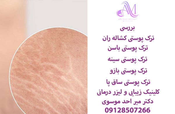 ترک پوستی کشاله ران