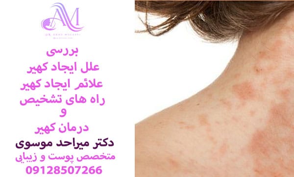 علل ایجاد کهیر