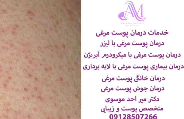 درمان پوست مرغی با لیزر