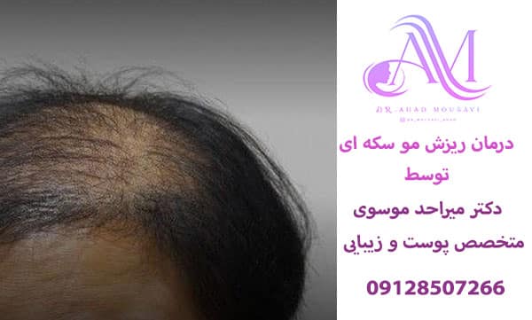 درمان ریزش مو سکه ای