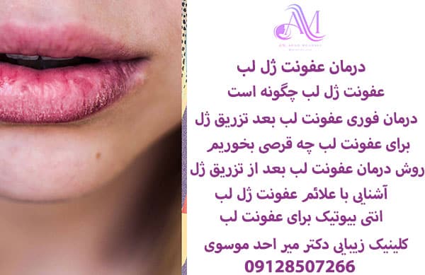 درمان عفونت ژل لب
