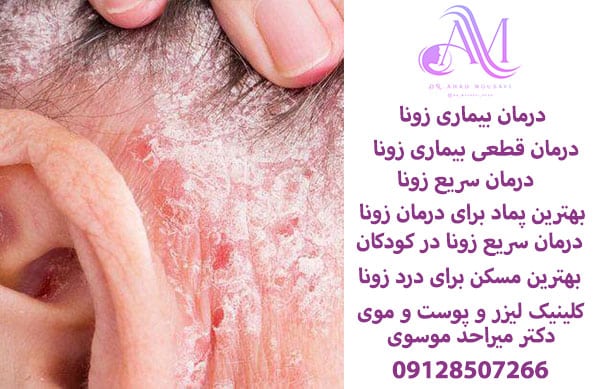 درمان بیماری زونا