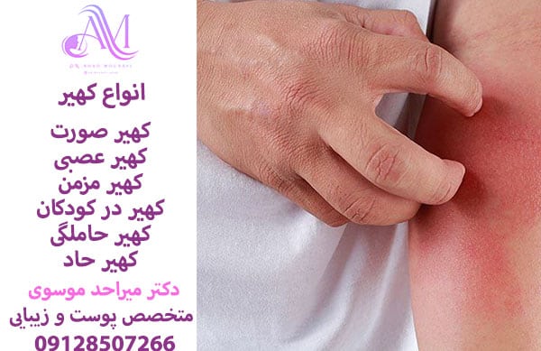 انواع کهیر پوستی