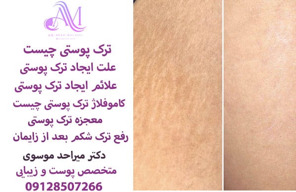 ترک پوستی چیست