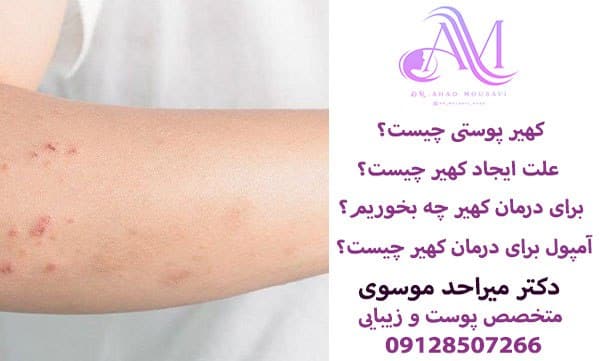 کهیر پوستی چیست