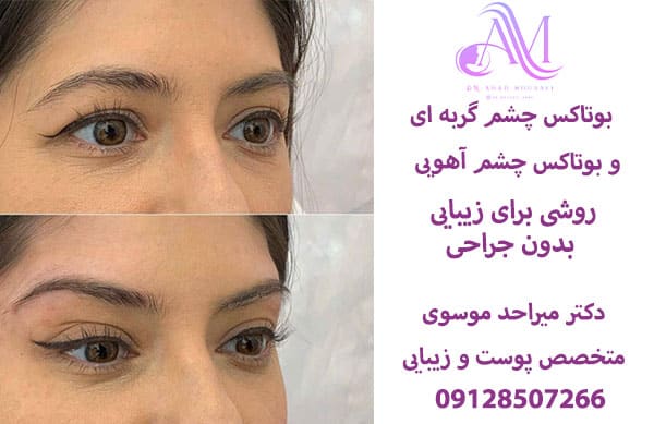 بوتاکس چشم گربه ای