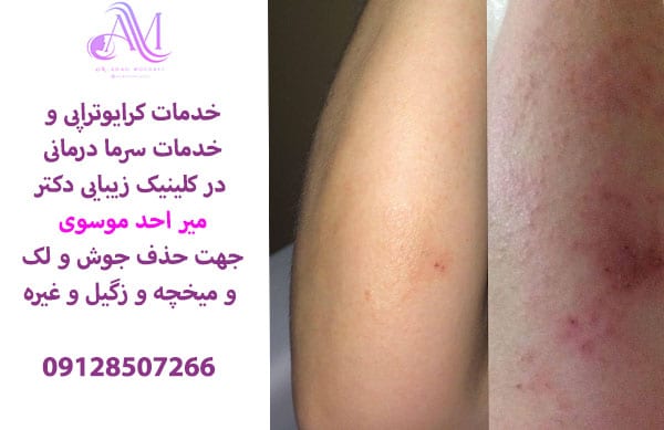 خدمات کرایوتراپی