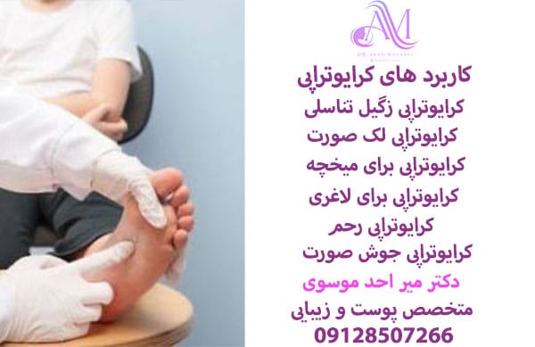 کرایوتراپی زگیل تناسلی