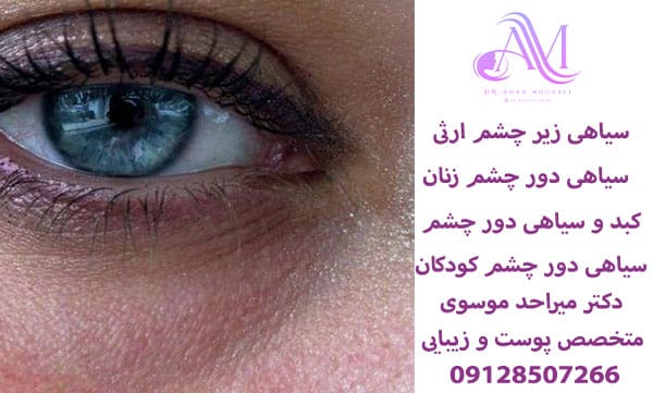 سیاهی دور چشم