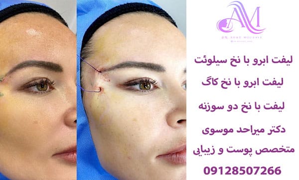 لیفت ابرو با نخ کاگ