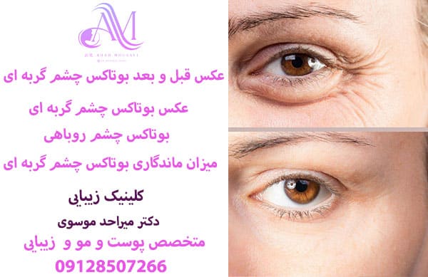 بوتاکس چشم روباهی